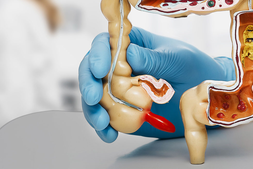Appendicite aiguë - CCGD Chirurgie digestive Lyon