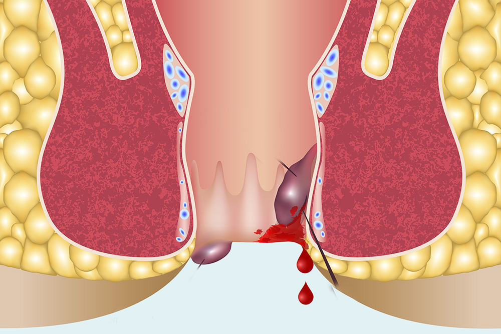 hemorroides2
