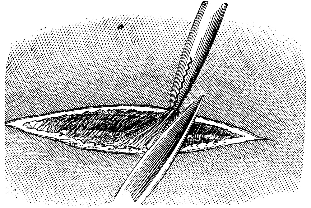 ligature_arterielle